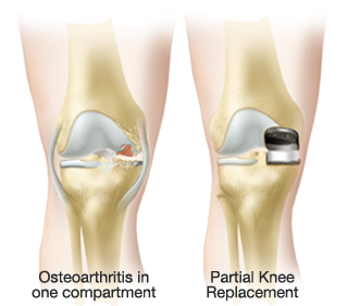 knee ostheoarthritis bicos